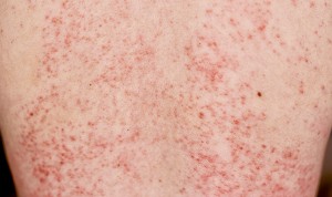 Un informe reciente de la Aemps detalla que el 84% de los problemas derivados por productos cosméticos en España durante el 2022 son de dermatitis