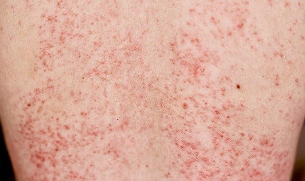 La dermatitis copa el 84% de los problemas causados por los cosméticos