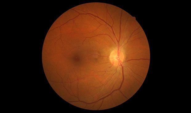 La diabetes tipo 1 afecta de forma similar al ojo y el corazón