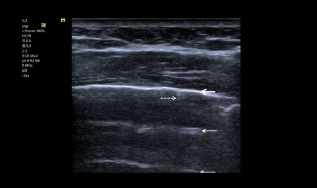La ecografía torácica, clave para medir la gravedad en neumonía por Covid
