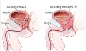 La embolización prostática, terapia efectiva para la hiperplasia prostática
