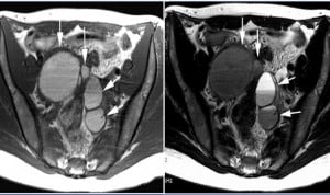 La escleroterapia guiada por ultrasonido muestra una eficacia del 98,3%