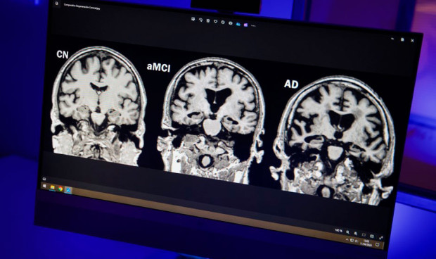 Tratamiento contra el alzheimer.