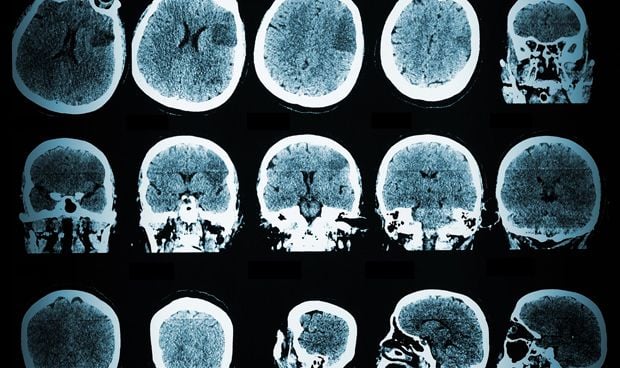 La estimulacin elctrica sincronizada del cerebro mejora la memoria