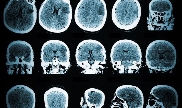 La estimulación eléctrica sincronizada del cerebro mejora la memoria