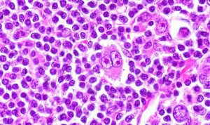 La etapa de diagnóstico del linfoma predice cuándo se forma un nuevo tumor