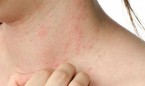 La evolución de la dermatitis atópica 