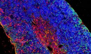 La evolución genética de células de la leucemia condiciona el pronóstico