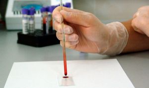 La falta de recursos lastra el uso de técnicas moleculares en Hematología