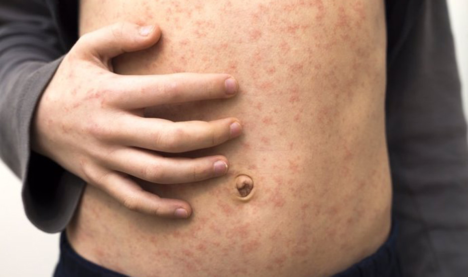 Las infecciones alimentarias altamente prevenibles se multiplican por casi diez en Europa