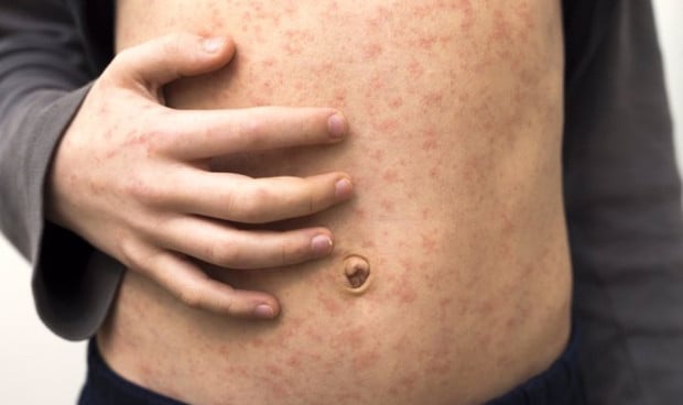 Las infecciones alimentarias altamente prevenibles se multiplican por casi diez en Europa