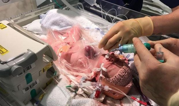 La historia del bebé que nació con el corazón fuera del pecho y sobrevivió 