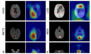 La IA detecta y clasifica los tumores cerebrales con resonancia magnética