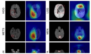 La IA detecta y clasifica los tumores cerebrales con resonancia magnética