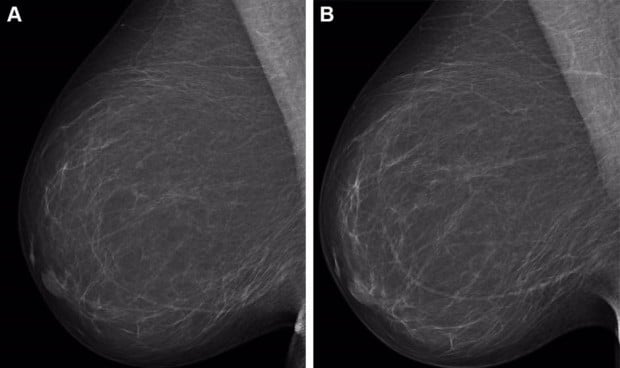  Mamografías digitales de campo completo (vista oblicua mediolateral derecha).