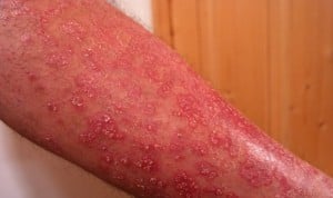 La Justicia dictamina que la psoriasis es motivo de incapacidad permanente