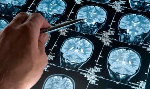 La magnetoencefalografía discrimina la causa de la pérdida de memoria