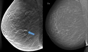 La mamografía, útil para determinar el riesgo de mujeres a sufrir un ictus