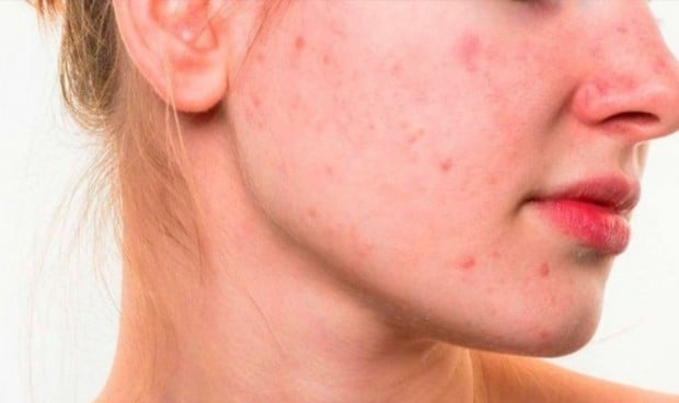 La mascarilla origina el 54% de las reacciones cutáneas en la cara