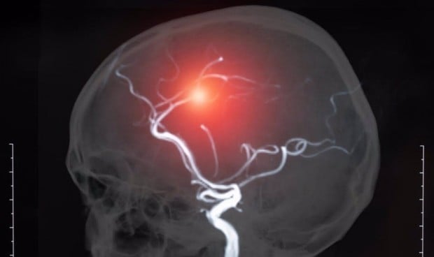 Pruebas de imagen para diagnosticar pacientes con ictus