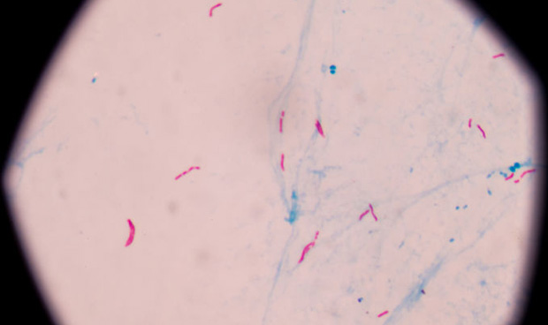 La necesidad de grasa, 'taln de Aquiles' de la bacteria de la tuberculosis