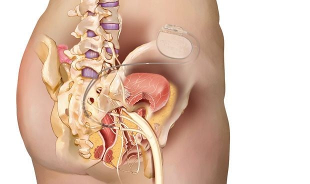 La neuromodulación sacra, efectiva en el 89% de pacientes con incontinencia