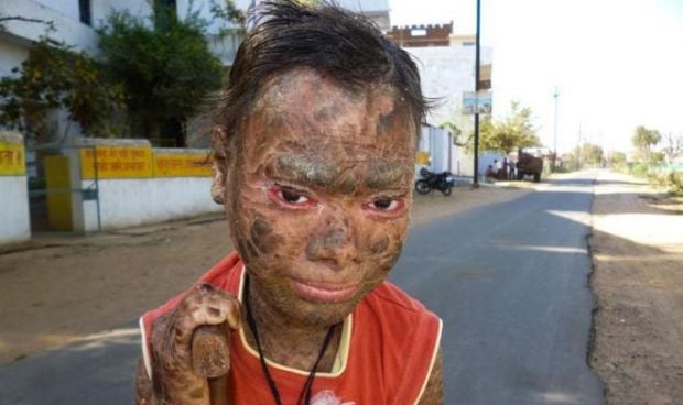 La niña con 'piel de serpiente' sueña con estudiar Medicina