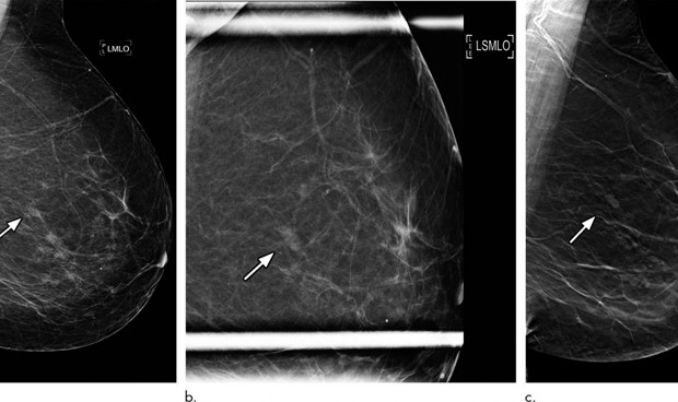 La obesidad fomenta la aparición del cáncer de mama más agresivo y mortal