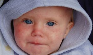 La OMS alerta de que los casos de sarampión en Europa se han cuadruplicado