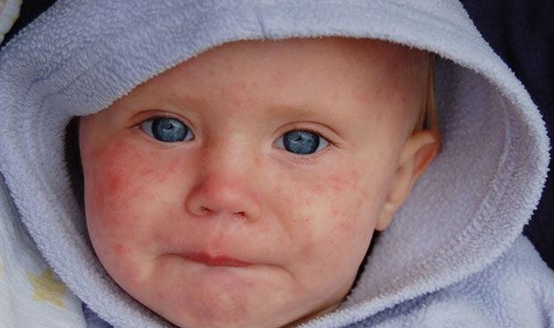 La OMS alerta de que los casos de sarampión en Europa se han cuadruplicado