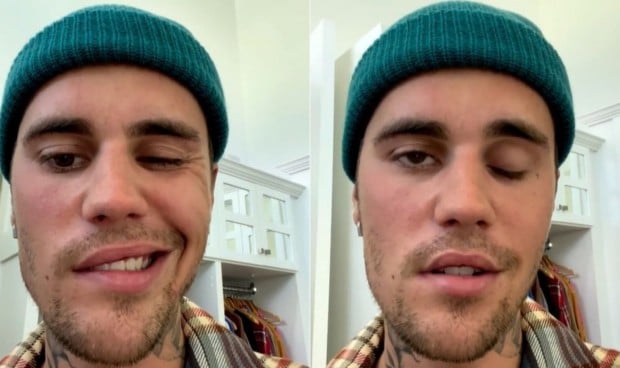 La parálisis de Bieber encaja como secuela covid y efecto adverso de vacuna