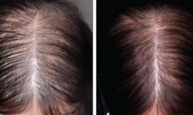La prevalencia de la alopecia areata en niños se duplica en 10 años