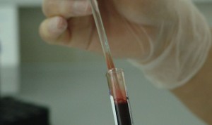 La primera 'pista' para dar con el párkinson está en los análisis de sangre
