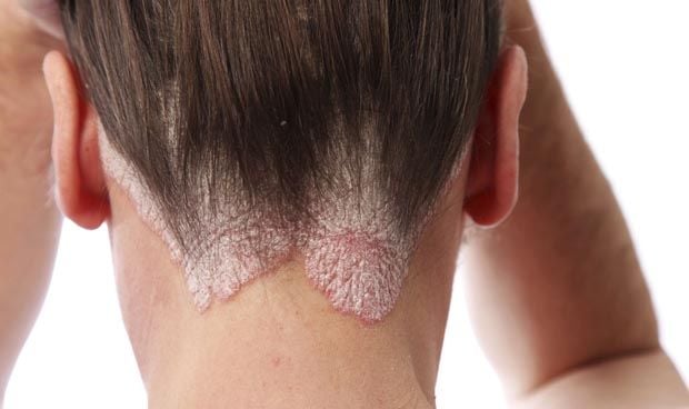 La psoriasis afecta de forma grave o muy grave a 2 de cada 10 pacientes