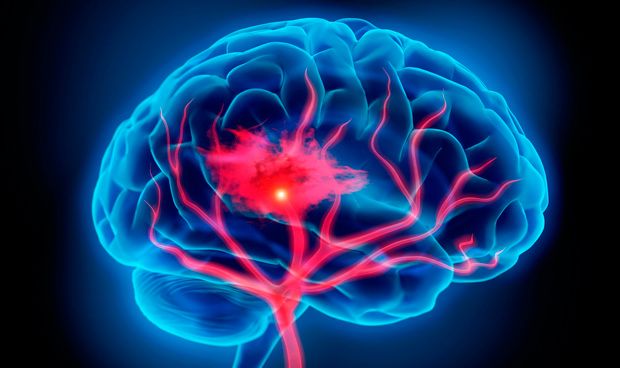 La recuperacin de accidente cerebrovascular mejora con privacin sensorial