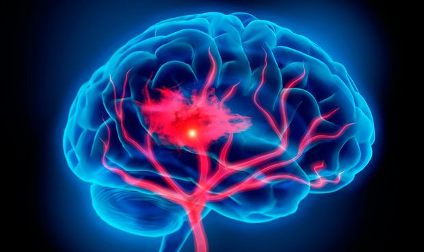 La recuperación de accidente cerebrovascular mejora con privación sensorial