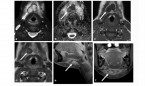 La resonancia, la técnica que mejor halla abscesos de cuello en niños