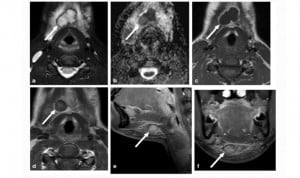 La resonancia, la técnica que mejor halla abscesos de cuello en niños