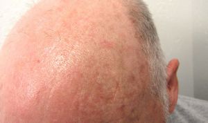 La terapia con microagujas reduce la queratosis actínica hasta en un 76% 