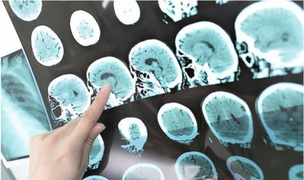 Nuevo indicador para conocer la salud cerebral en adultos