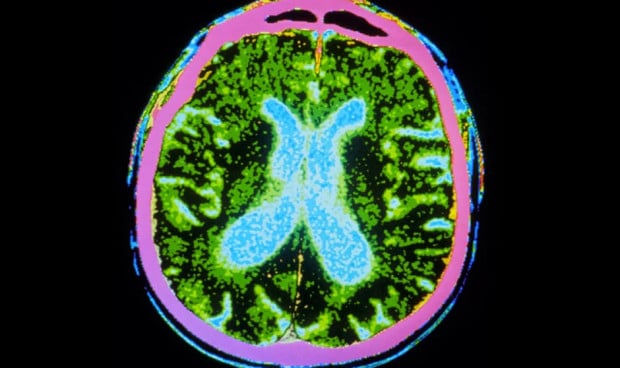 Las células madre contra el párkinson apuntan a éxito en humanos