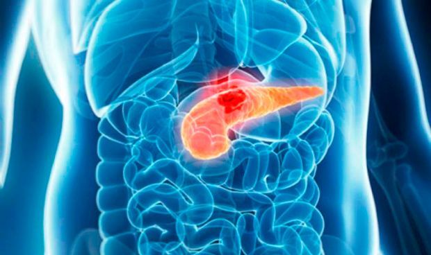 Las muertes por cáncer de páncreas en Europa casi superan a las de mama
