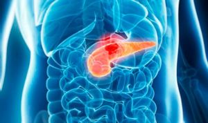 Las muertes por cáncer de páncreas en Europa casi superan a las de mama