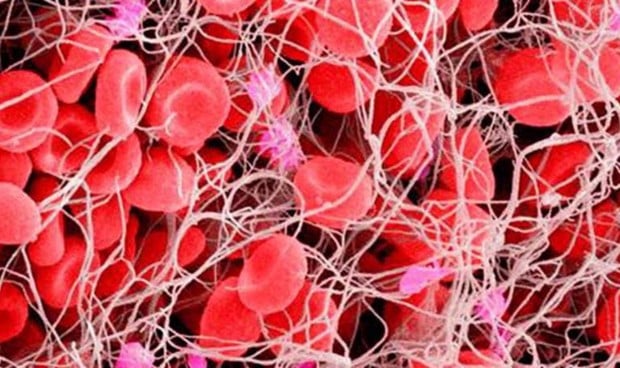 The risk of venous thromboembolism is increased in women with diabetes mellitus