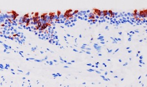 Las personas infectadas con Ómicron pueden reinfectarse con subvariantes