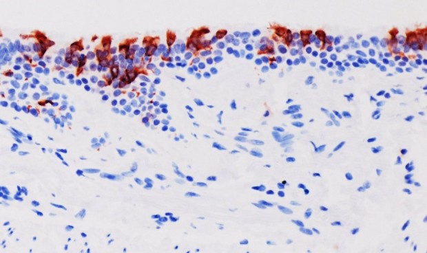 Las personas infectadas con Ómicron pueden reinfectarse con subvariantes