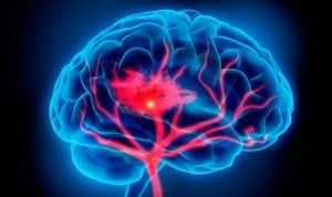Las lesiones cerebrales traumáticas, ligadas a riesgo de ictus hasta 5 años