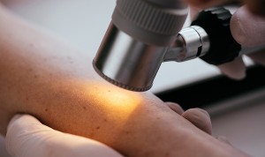 Logran predecir qué pacientes con melanoma responden al tratamiento