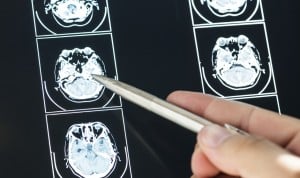 Logran que la quimioterapia llegue al cerebro con un aparato de ultrasonido