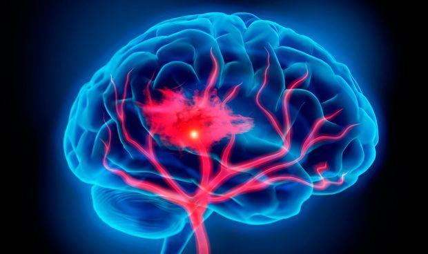 Los accidentes cerebrovasculares duplican el riesgo de sufrir demencia